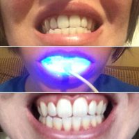 LED Teeth Whitening Kit brasher bunch 2048x