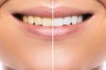 Teeth Before and after Diamond Smile Use